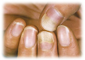 接触性皮膚炎による爪甲剥離症
